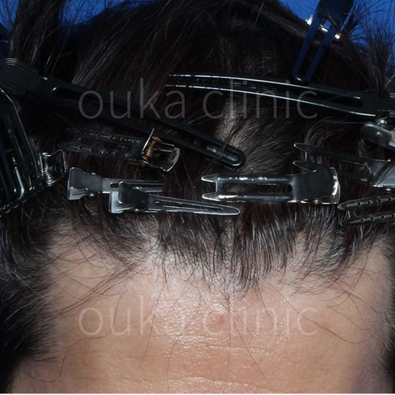 M字　頭頂の治療前の画像